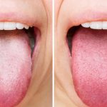 Warna Lidah Bisa Jadi Cermin Kesehatan Tubuh