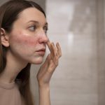 Rosacea Bikin Wajah Merah dalam Jangka Panjang